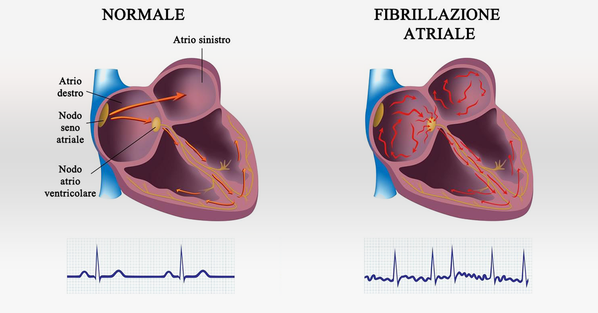 Modello cardiaco del nodo senoatriale