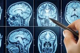 '' TUMORI  AL  CERVELLO -LE  STATISTICHE  - Informazioni -NATIONAL  BRAIN  TUMOR  SOCIETY ''